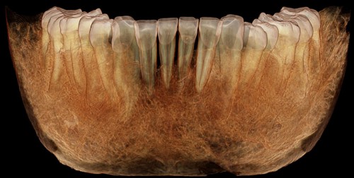 I denti costituiscono i resti più numerosi e meglio preservati nel registro fossile dei vertebrati, incluso quello degli ominidi, la nostra famiglia zoologica. Le analisi di immagine 3D permettono di catturare dettagli morfologici finissimi, come nel caso della mandibola neandertaliana di Regourdou, nel Périgord, Francia (immagine dell’autore)