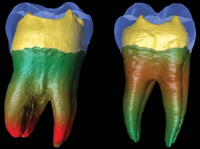 Ricostruzione virtuale in falsi colori di un primo molare inferiore di un umano moderno (a destra) e di un neandertaliano (La Chaise, Francia, a sinistra). La corona (in celeste) è rappresentata in trasparenza, mentre la dentina è in giallo. Il cromatismo delle radici schematizza alcune differenze tra le due specie nella velocità, ritmo e modalità di costruzione dello stesso tipo di dente (i colori “caldi” corrispondono a fasi di accrescimento più rapide rispetto a quelli “freddi”) (immagine dalla rivista Nature, 2006)