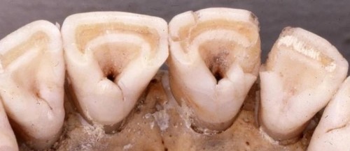 La morfologia “a pala” dei denti incisivi è uno dei caratteri morfologici diffusi nelle popolazioni asiatiche ed amerindiane associati ad una variante del gene EDAR che venne fissata nel genoma delle popolazioni umane paleoartiche intorno a 30-35,000 anni fa in quanto determinava soprattutto un aumento nelle capacità di allattamento materno in un contesto ambientale sfavorevole alla produzione naturale di vitamita D e di acidi grassi, fondamentali per la sopravvivenza dei neonati (immagine dell’autore)