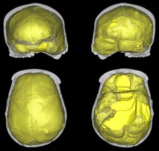 Ricostruzione virtuale in trasparenza del cranio del bambino neandertaliano di 430.000 anni fa ATA SH14, dal sito spagnolo di Atapuerca Sima de lo Huesos. La morfologia endocranica (in giallo) mostra gli effetti di una craniostenosi parieto-occipitale congenita che menomò profondamente le capacità cognitive ed il comportamento dell’individuo, che necessitò di continua vigilanza ed assistenza (immagine dalla rivista Proceedings of the National Academy of Sciences USA, 2009)